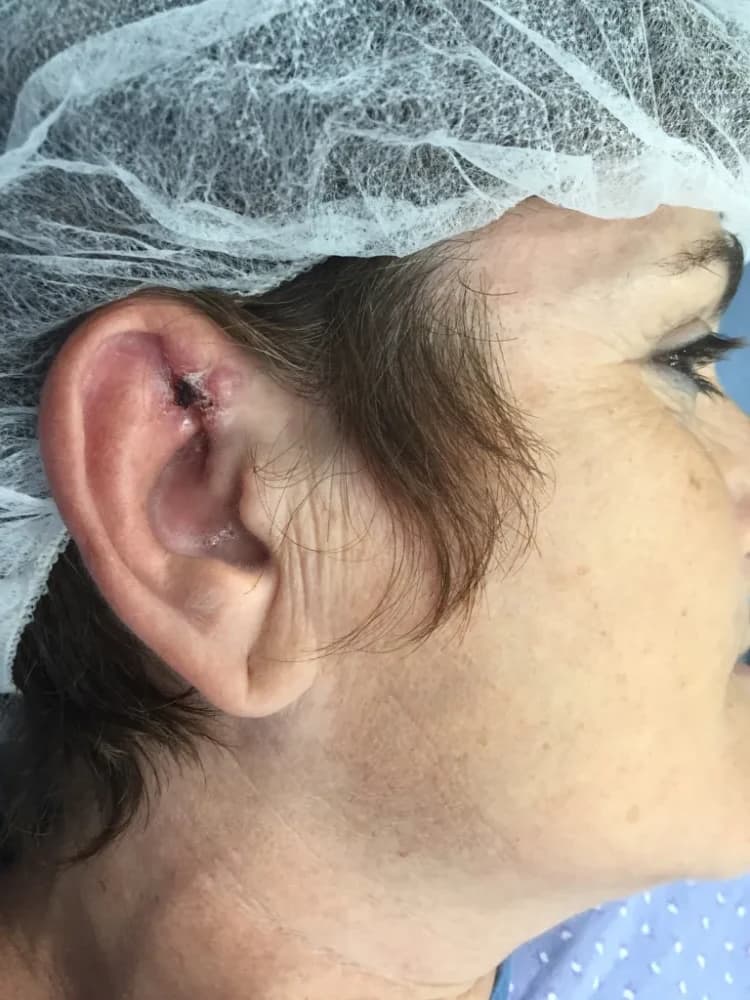 נגע קטן באוזן לפני ניתוח כריתה ושחזור